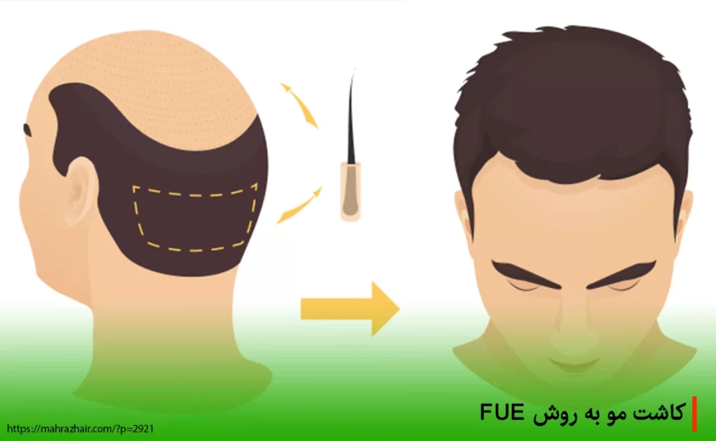کاشت مو به روش FUE